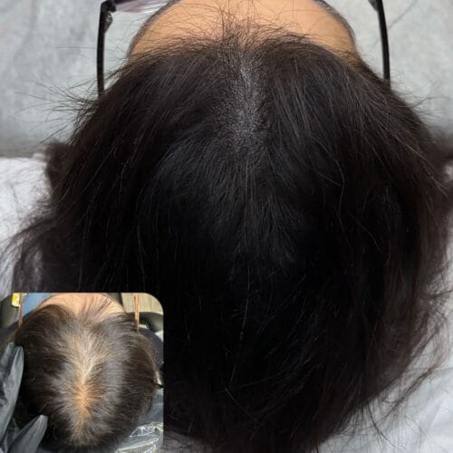 Scalp Micropigmentation Density for Women at DAELA Cosmetic Tattoo