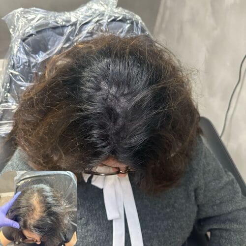 Scalp Micropigmentation Density for Women at DAELA Cosmetic Tattoo