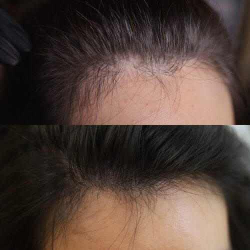Scalp Micropigmentation Density for Women at DAELA Cosmetic Tattoo