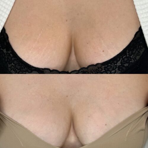 Stretch Mark Treatments in Scottsdale at DAELA Cosmetic Tattoo