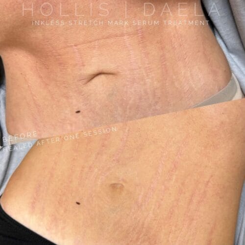 stretch mark camouflage in Scottsdale at DAELA