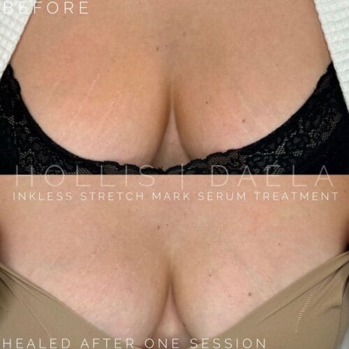 stretch mark camouflage daela scottsdale