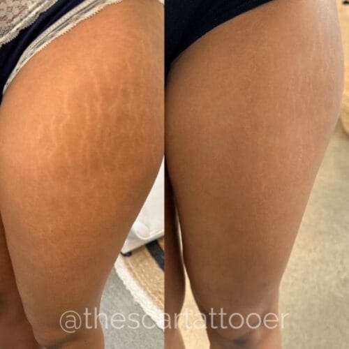 Stretch Mark Treatment Portland DAELA Cosmetic Tattoo Shonna