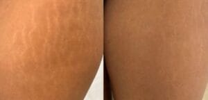 stretch mark camouflage