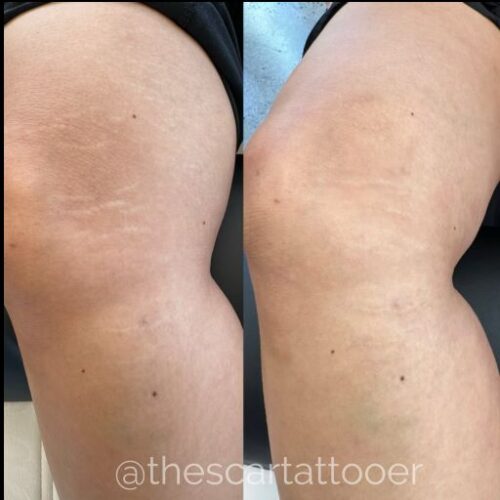 Stretch Mark Treatments Vancouver DAELA Shonna
