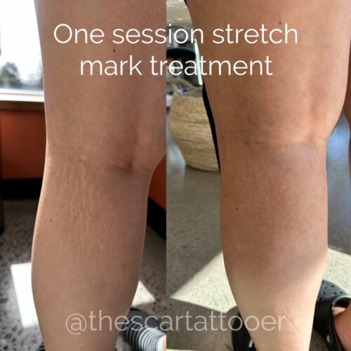 Stretch Mark Treatments Vancouver DAELA Shonna