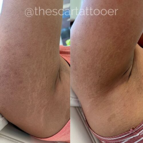 Stretch Mark Treatments Vancouver DAELA Shonna
