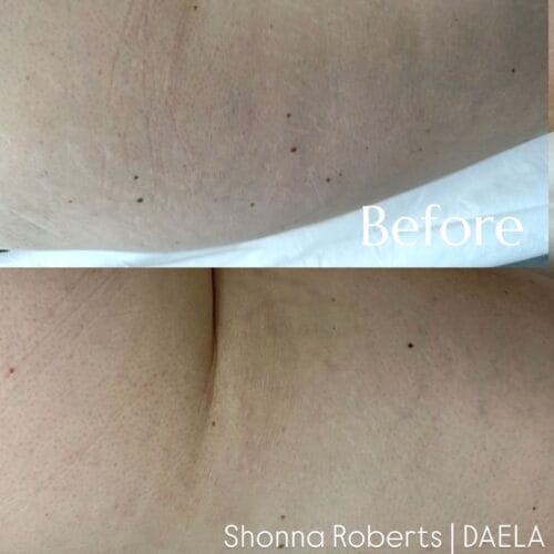 Stretch Mark Treatment Portland DAELA Cosmetic Tattoo Shonna