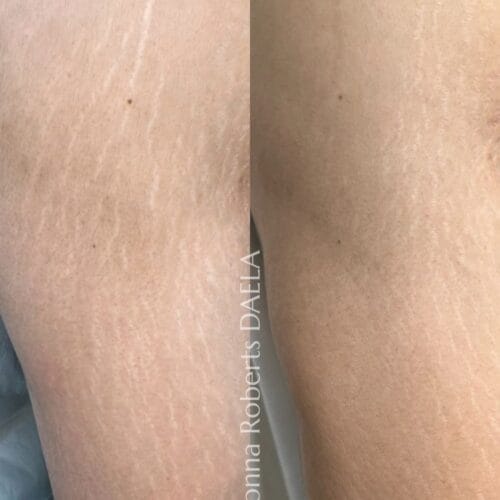 Stretch Mark Treatment Portland DAELA Cosmetic Tattoo Shonna
