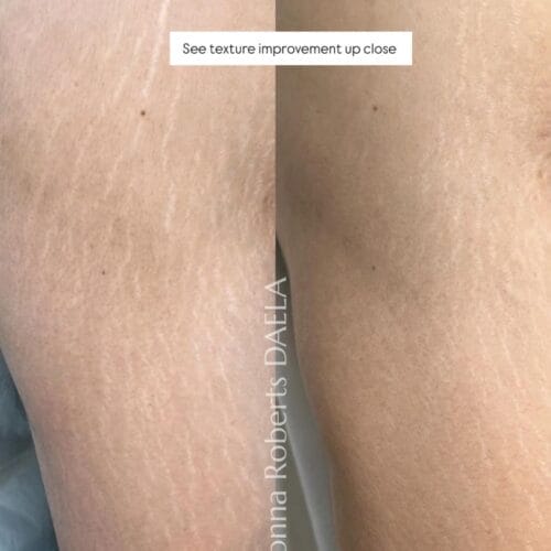 Stretch Mark Treatment Portland DAELA Cosmetic Tattoo Shonna
