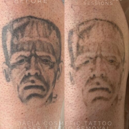 Laser tattoo Removal in Scottsdale at DAELA