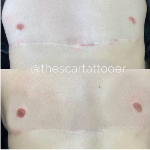 Top Surgery Scar Camouflage Tattoo Vancouver DAELA Shonna