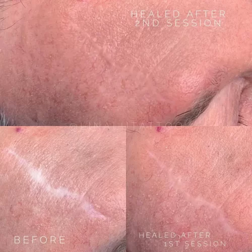 Scar Camouflage Tattoo DAELA Cosmetic Tattoo Portland-Shonna