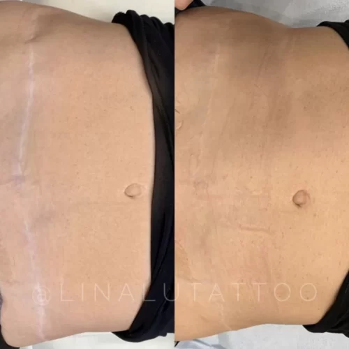 Scar Camouflage Tattoo DAELA Cosmetic Tattoo Portland-Shonna