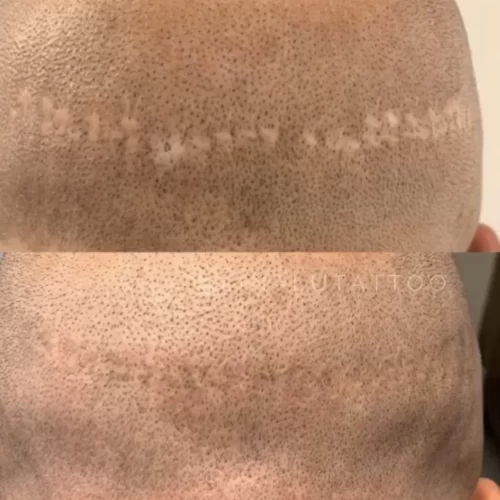 Scar Camouflage FUT and FUE scars vancouver daela shonna